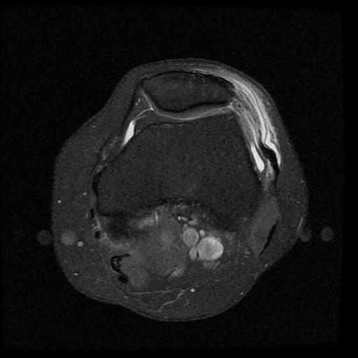 Figure 4 for case Lateral patellar retinaculum tear